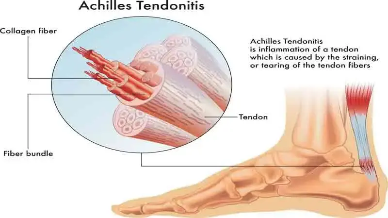 Understanding Tendonitis