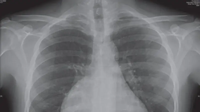 Right Atrial Enlargement