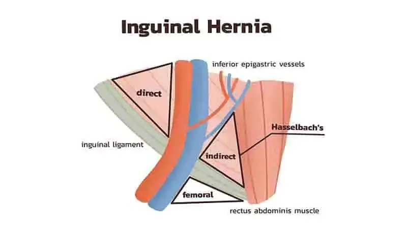 difference-between-direct-and-indirect-inguinal-hernia