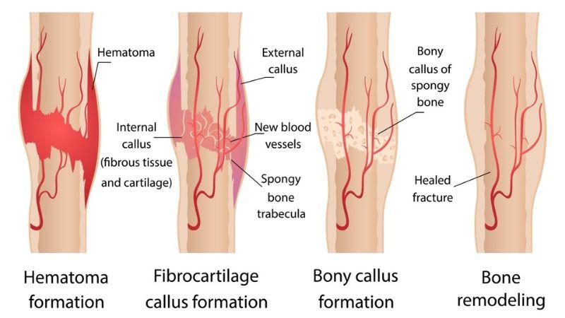 First Aid for Fracture