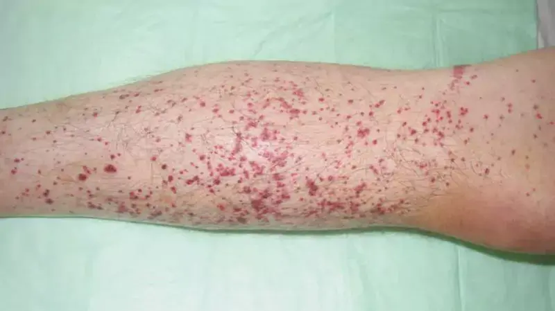 mild petechiae arms