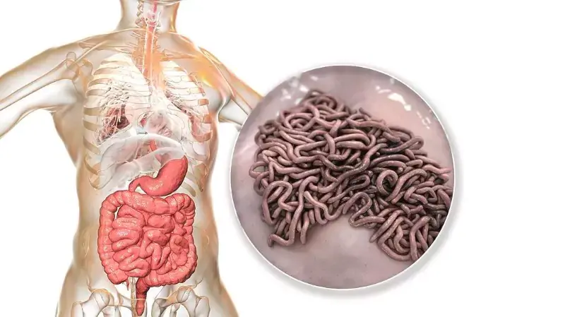 Ascariasis : Causes and Treatment Options, Symptoms