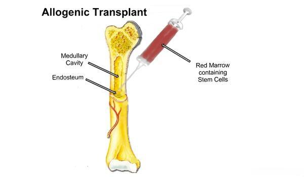 glutathione and bone marrow transplant Hematopoietic Stem-Cell Transplantation Autologous Stem Cell (Bone Marrow)