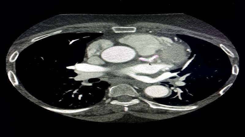 Coronary Artery Calcium Scan - The Heart-smart Test That Could Save ...