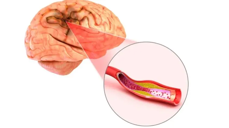 Blood Clot in Brain: Symptoms, Diagnosis, and Treatment