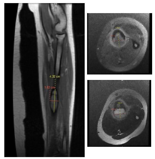 Case Report: Aneurysmal bone cyst treated with percutaneous sclerotherapy