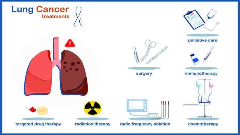 Immunotherapy for Lung Cancer: A Revolutionary Approach to Treatment