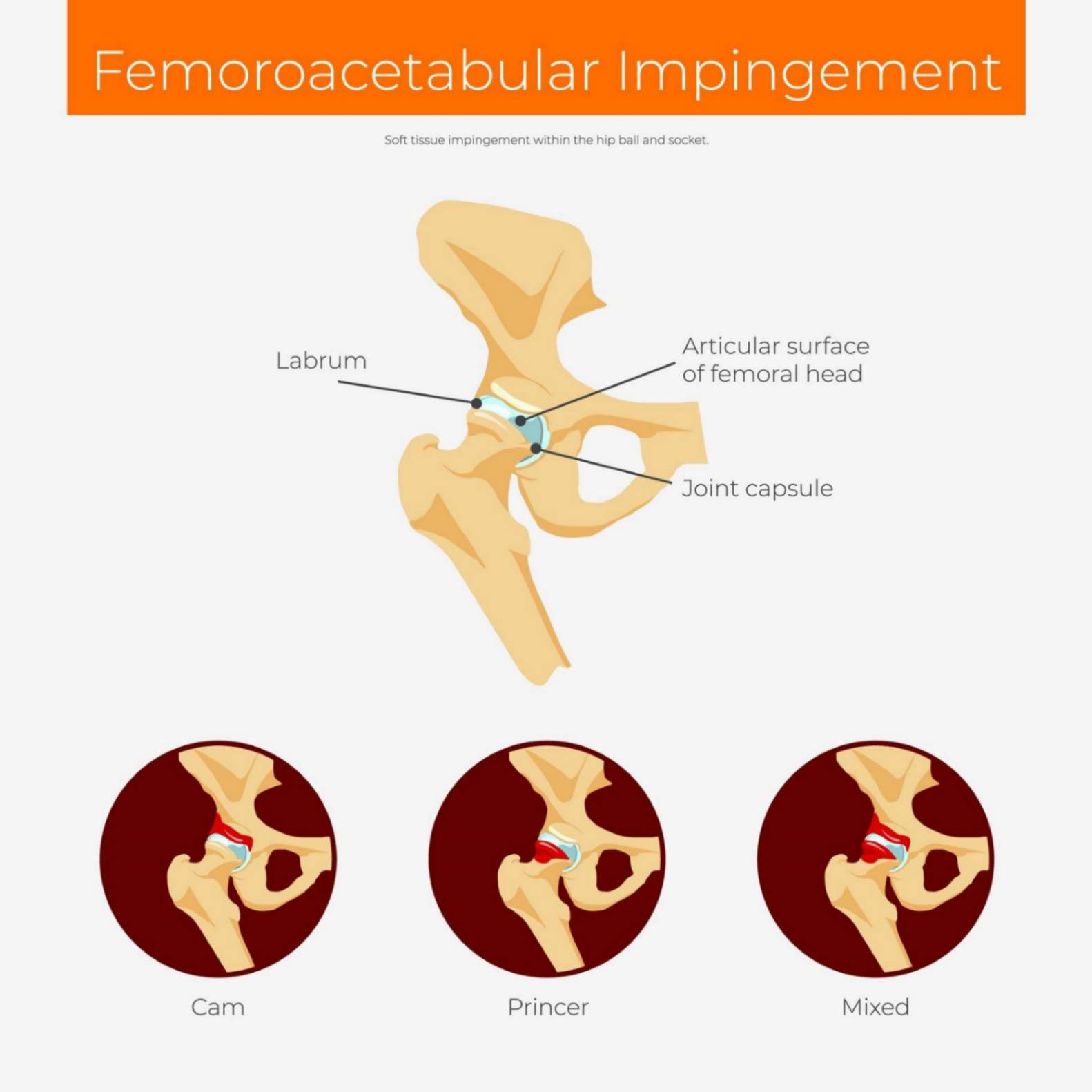 Female Groin Pain - Causes and Treatment Options Female Groin Pain - Causes and Treatment Options