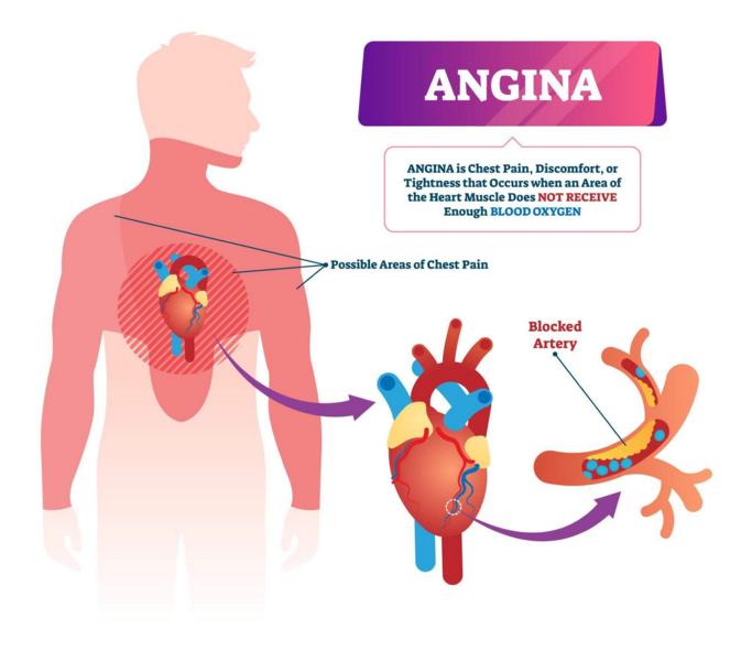 tobacco angina Angina Pectoris
