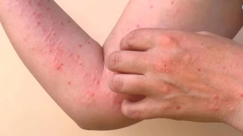 Chikungunya Chikungunya