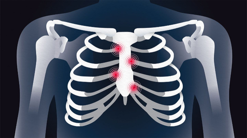 ice pack for costochondritis