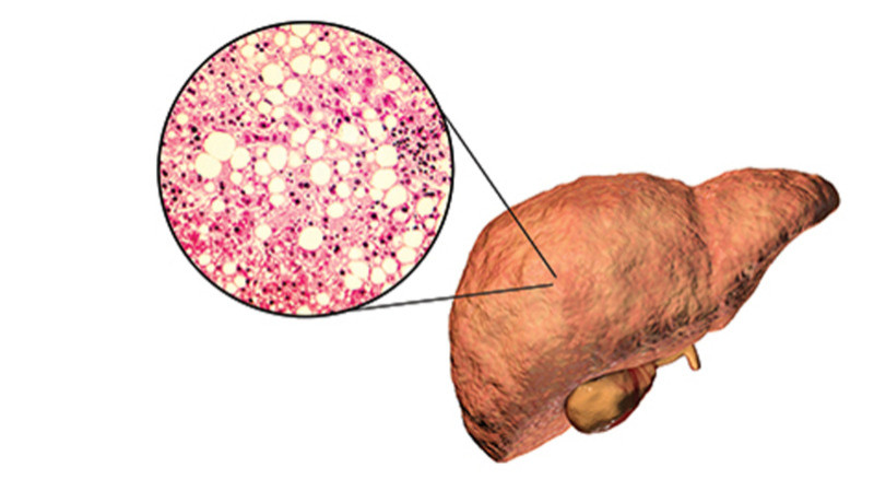 Grade 1 Fatty Liver