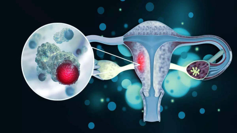 Cervical Cancer: Causes, Symptoms, and Treatment Options | Narayana Health