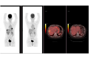 stereotactic-body-radiotherapy_image