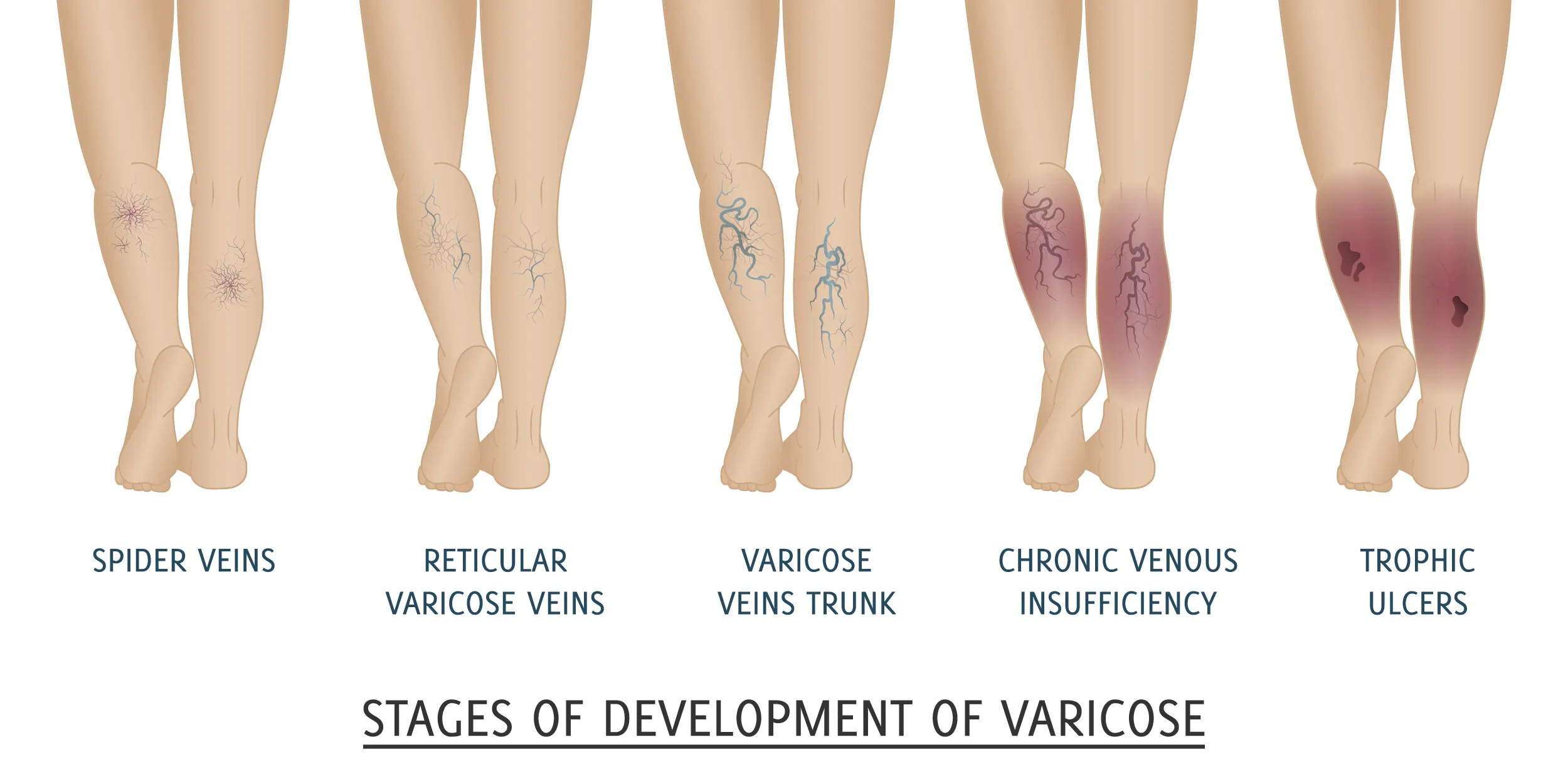 My Varicose Veins Have Red Spots. Why? Will They Go Away?