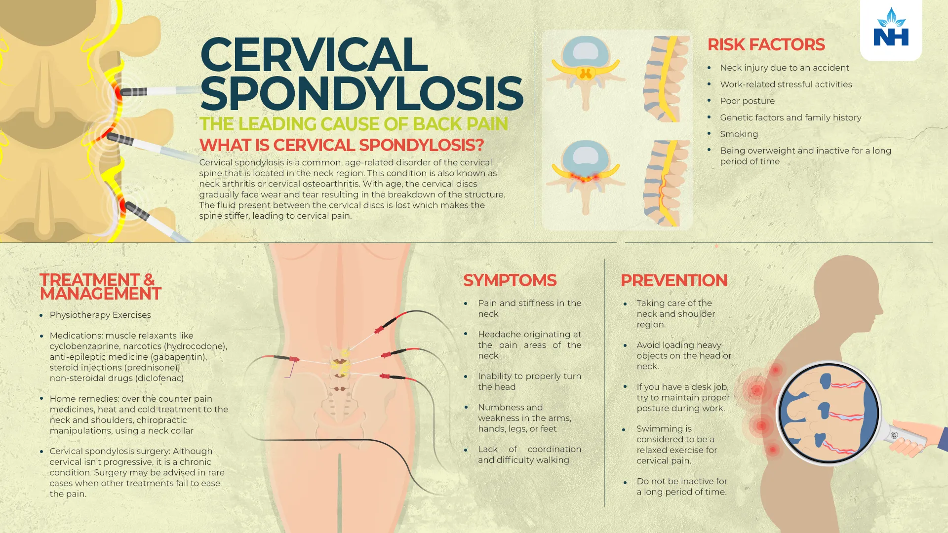 Lumbar and Cervical Spondylosis: Symptoms & Treatments